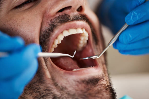 Best Knocked-Out Tooth (Avulsed Tooth) Treatment in Gothenburg, NE